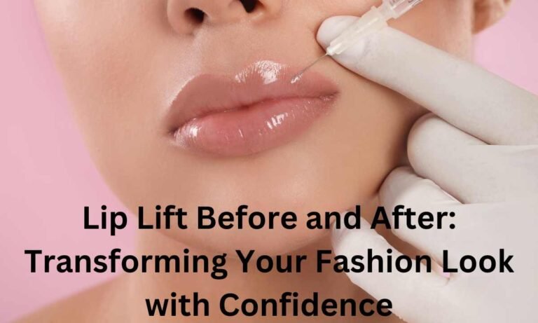 Lip Lift Before and After