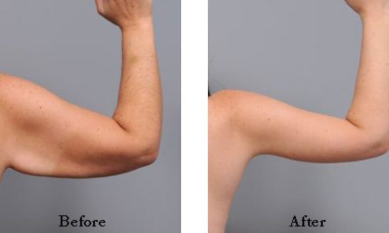 Arm Lipo Before and After