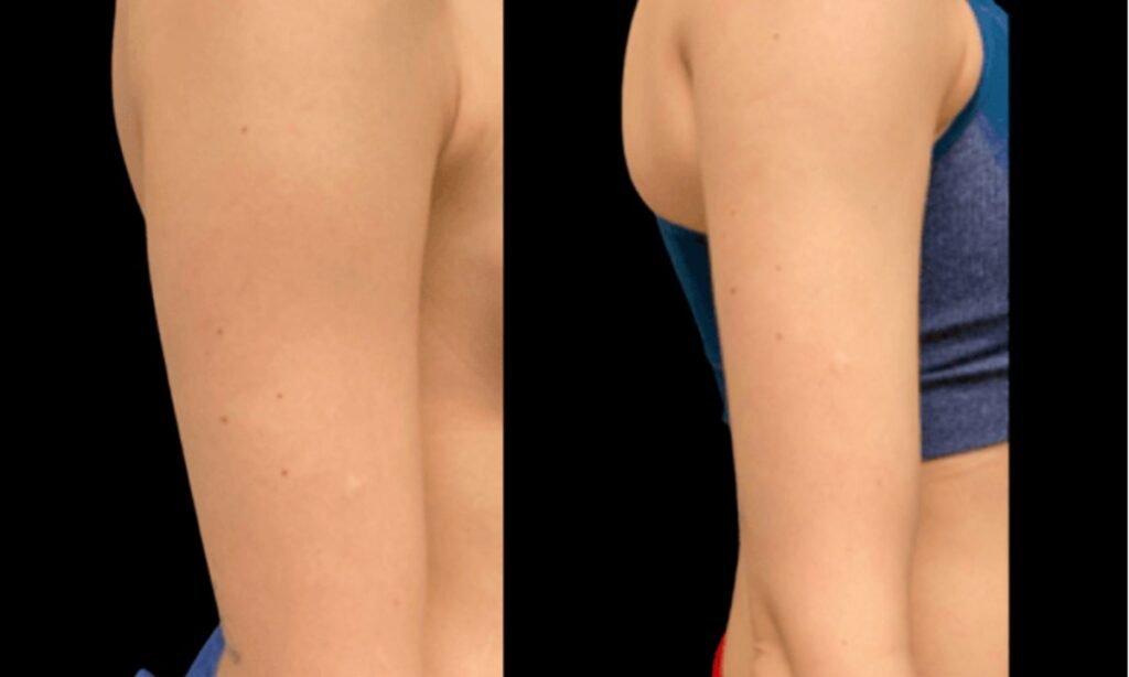 Arm Lipo Before and After transformation